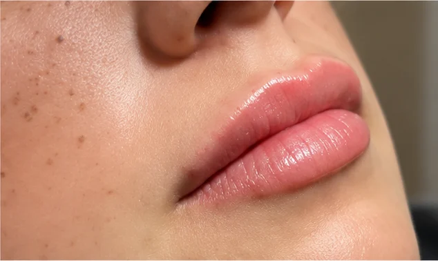 Depois: os mesmos lábios após o preenchimento labial (caso 02)