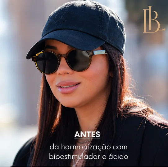 Antes: paciente de óculos escuros e boné, antes da harmonização com bioestimulador e ácido