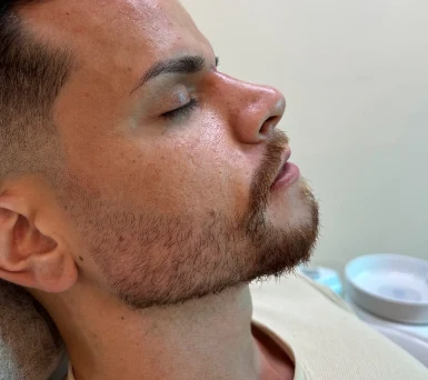 Perfil de paciente masculino com barba após harmonização facial